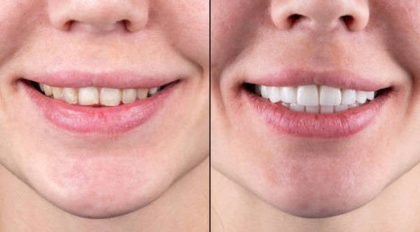 Real Patient Smile Transformation Before and After